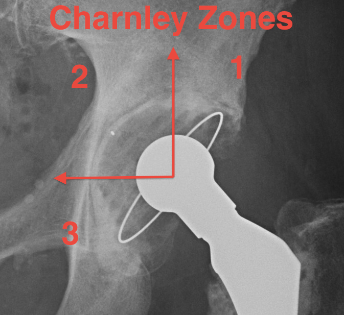 Charnley Zones